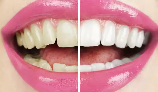 Жълти зъби - причини и съвети за избелване